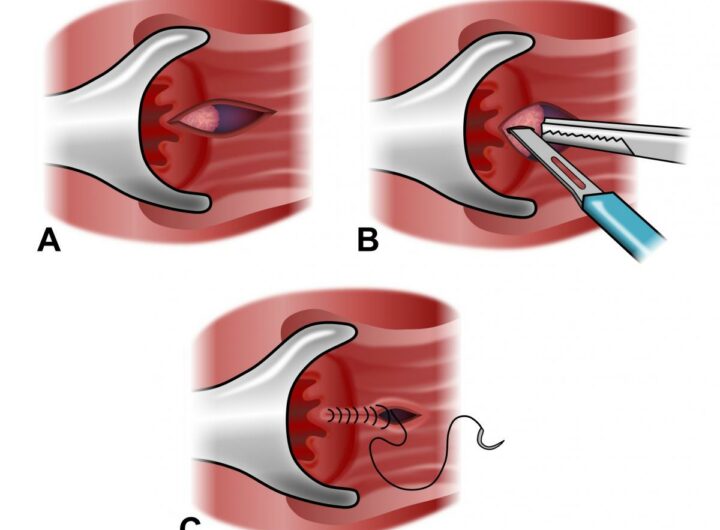 Anal Fissure Treatment